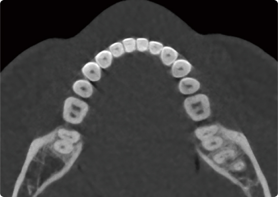 After beam hardening artifact reduction